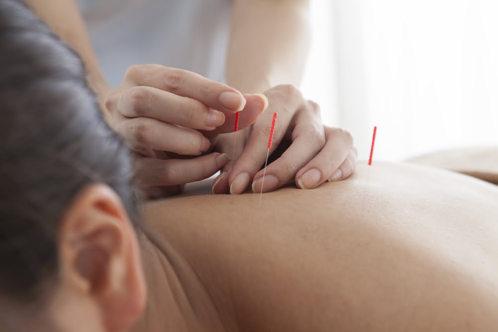 Acupuncture for Sleep: Can It Help You Achieve Restful Nights